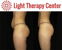 Light Therapy Center