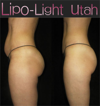 Lipo-Light Utah