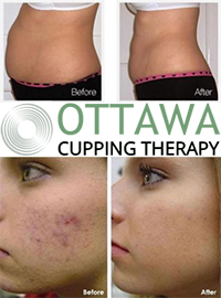 Ottawa Cupping Therapy