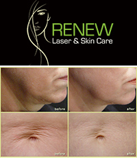 Renew Laser and Skincare
